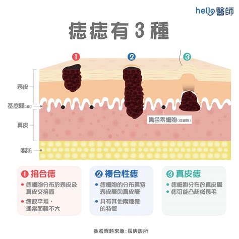 臉上多了痣|痣形成的原因？痣長毛、痣變多變大是痣病變？5招判。